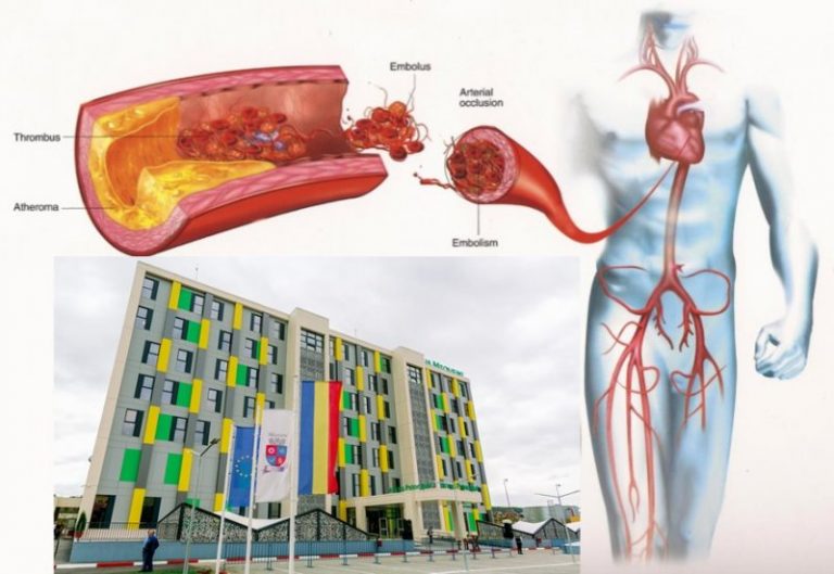 S-a realizat prima operație de angioplastie, la Mioveni! S-a realizat prima operație de angioplastie, la Mioveni!